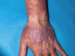 Lichenoid drug eruption
