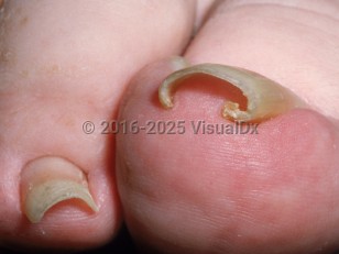 Pincer nail deformity