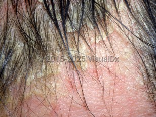 Clinical image of Pityriasis amiantacea - imageId=3022928. Click to open in gallery.  caption: 'Thick, adherent scales on the scalp and around the hair shafts.'