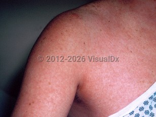Clinical image of Measles - imageId=303754. Click to open in gallery.  caption: 'Widespread erythematous, confluent macules and patches on the chest and arm.'