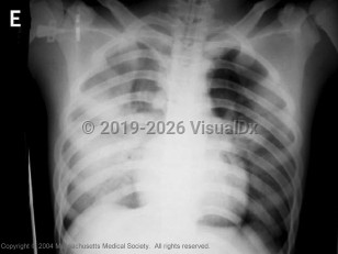 Imaging Studies image of Avian influenza - imageId=3042057. Click to open in gallery.  caption: '&nbsp;Hien, Liem, Dung, San, Mai, Chau, Suu, Dong, Mai, Thi, Khoa,&nbsp;<br>&nbsp;Phat,Truong, Long. "Avian Influenza A (H5N1) in 10 Patients in&nbsp;<br>&nbsp;Vietnam." New England Journal of Medicine 2004; 350:1179-1188.&nbsp;<br>&nbsp;http://content.nejm.org/cgi/content/full/350/12/1179&nbsp;<br><br>'