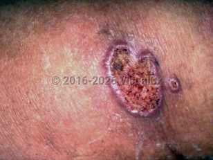 Paracoccidioidomycosis