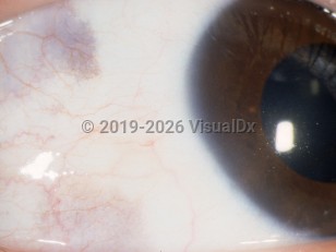 Conjunctival melanosis