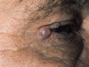 Eccrine hidrocystoma