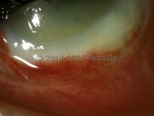 Ophthalmic Imaging image of Ocular alkali burn - imageId=3104316. Click to open in gallery. 