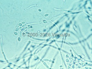 Vulvovaginal candidiasis