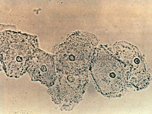 Lab image of Bacterial vaginosis - imageId=311617. Click to open in gallery.  caption: 'Clue cells seen on a wet mount.'