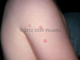 Bedbug bite