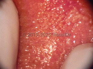 Vestibular papillomatosis