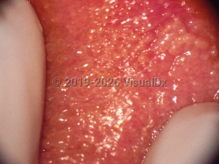 Vestibular papillomatosis