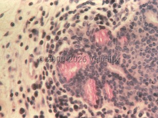Vulvodynia