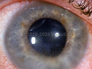 Uveitis