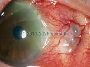 Necrotizing scleritis