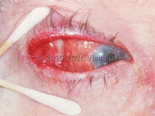 Clinical image of Lacrimal gland tumor - imageId=3180152. Click to open in gallery.  caption: 'A glistening mass at the lateral eye with marked conjunctival injection.'