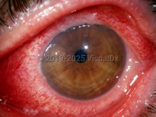 Bacterial conjunctivitis