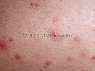Clinical image of Folliculitis - imageId=320768. Click to open in gallery.  caption: 'A close-up of follicularly based papules and a pustule.'