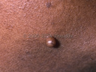 Cutaneous neuroma