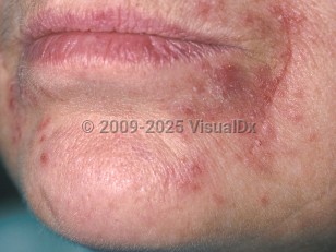 Periorificial dermatitis