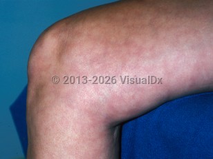 Livedo reticularis
