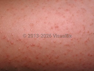 Clinical image of Keratosis pilaris - imageId=32898. Click to open in gallery.  caption: 'A close-up of follicularly-based, scaly, erythematous papules.'