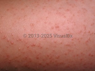Keratosis pilaris