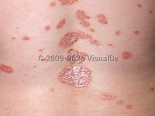 Psoriasis