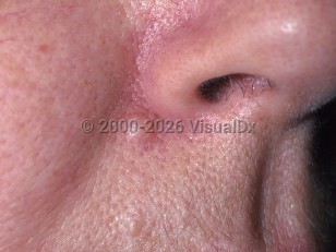Clinical image of Common acquired nevus - imageId=329792. Click to open in gallery.  caption: 'A skin-colored papule (intradermal nevus) at the nasal alar crease.'