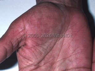 Hepatitis C virus infection
