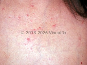 Alcohol use disorder