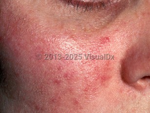 Rosacea