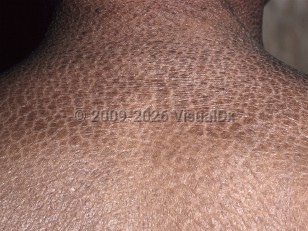Ichthyosis vulgaris