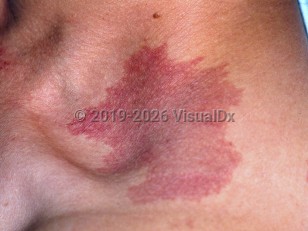 Port-wine birthmark