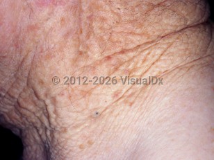 Solar elastosis