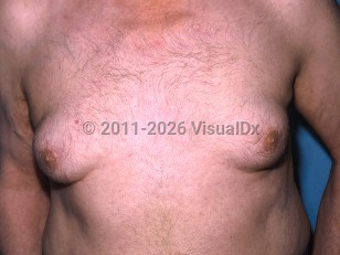 Clinical image of Gynecomastia - imageId=336348. Click to open in gallery.  caption: 'Enlarged breasts, secondary to spironolactone.'