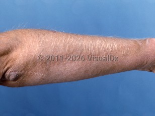 Clinical image of Acquired hypertrichosis lanuginosa - imageId=336883. Click to open in gallery.  caption: 'Marked hypertrichosis lanuginosa on the arm, secondary to cyclosporine.'