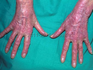 Clinical image of Drug-induced photoallergic reaction - imageId=341044. Click to open in gallery.  caption: 'Widespread scaly and crusted pink plaques on the dorsal hands and fingers, secondary to quinine.'