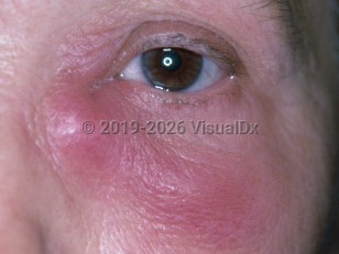 Dacryocystitis