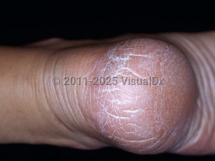 Clinical image of Heel fissure - imageId=3446788. Click to open in gallery.  caption: 'Linear cracks and surrounding hyperkeratosis of the heel.'