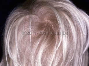 Loose anagen syndrome