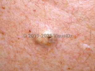 Epidermoid cyst