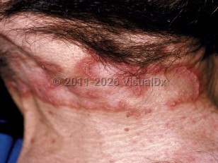 Elastosis perforans serpiginosa