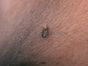 Acrochordon