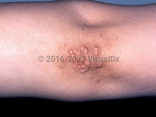 Tuberous xanthoma