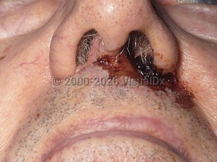Trigeminal trophic syndrome