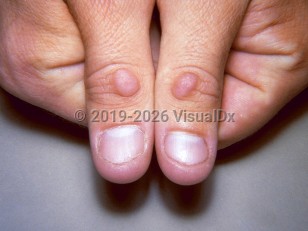 Knuckle pads