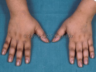 Clinical image of Cushing syndrome - imageId=358243. Click to open in gallery.  caption: 'Velvety hyperpigmented plaques (acanthosis nigricans) over the knuckles.'