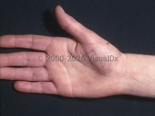 Acrocyanosis
