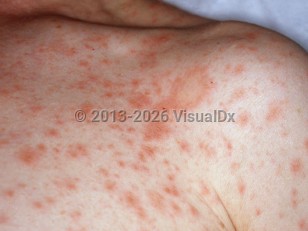 Pityriasis rosea