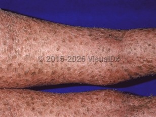 Clinical image of Lamellar ichthyosis - imageId=37020. Click to open in gallery.  caption: 'Diffuse brown ichthyotic scales on the posterior legs.'