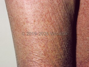 Acquired ichthyosis